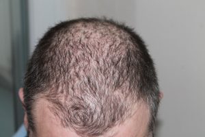 生髮治療,頭皮保養資訊彙整